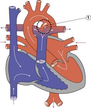 Diagram 2.4 Patent ductus arteriosus