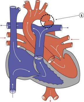 Diagram 2.9 - Coarctation of the Aorta