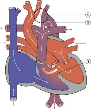 Diagram 2.10 - interrupted aortic arch