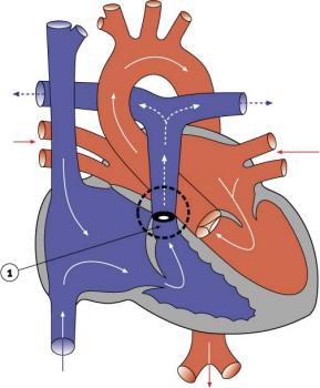 Pulmonary stenosis (valvular)