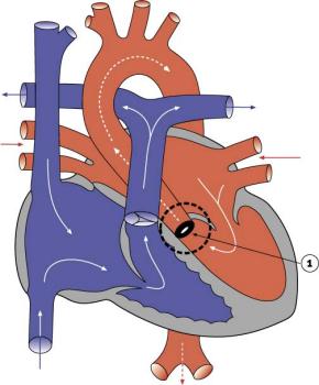 Diagram 2.12 - Aortic stenosis (valvular)