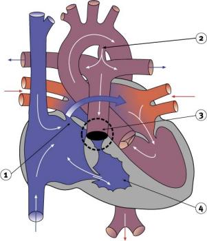 Diagram 2.14 - Pulmonary atresia