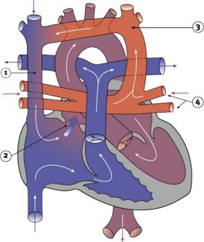 Diagram 2.15 - Total Anomalous pulmonary venous connection