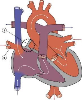 Diagram 2.16 - Partial anomalous pulmonary venous drainage