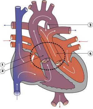 Diagram 2.17 - Transposition of the great arteries