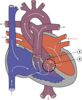 Diagram 2.18 - Double outlet right ventricle