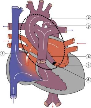 Diagram 2.19 - Hypoplastic left heart syndrome