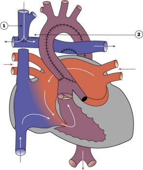 Diagram 2.22 - Stage 2 of hypoplastic left heart syndrome reconstruction
