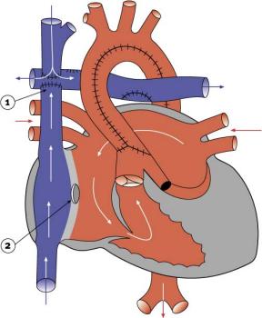 diagram 2.23 - Stage 3 of hypoplastic left heart syndrome reconstruction