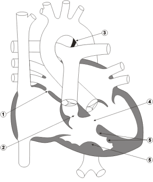 Diagram 6.1 - Garry Caribou's pre-operative heart