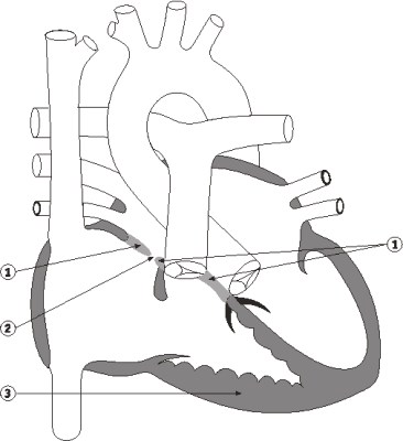 Diagram 7.2 Aric Baumann - post-operative heart