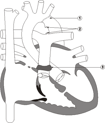 Diagram 7.4 Shalynn Piller - post-operative heart