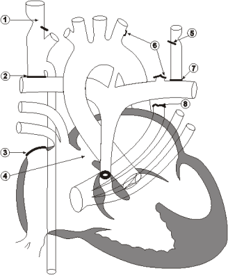 Diagram 8.2 Marietess Tena Capili - post-operative heart