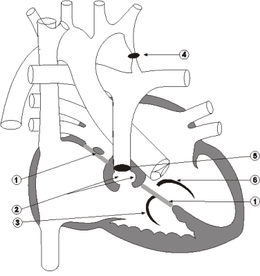 Diagram 8.6 Ashton Feakes - post-operative heart
