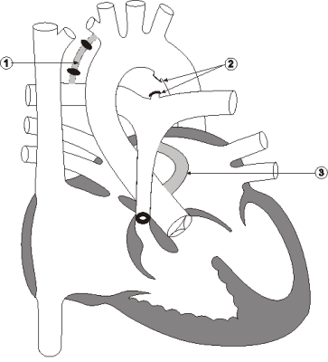 Diagram 8.10 Erin Petkau - post-operative heart