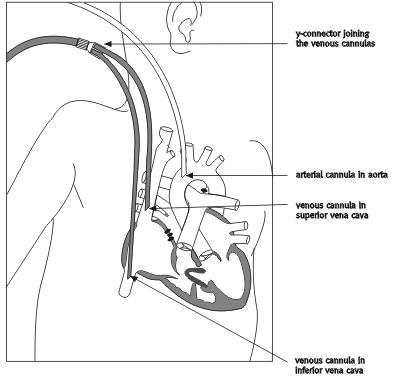 Diagram 6.5 - Depiction of the connection of the ECMO lines to Jessica Ulimaumi